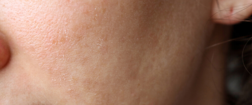closeup of dry skin