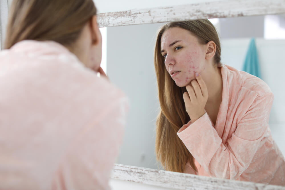 girl mirror acne